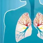 Թոքերի քաղցկեղի բուժումը ժողովրդական միջոցներով