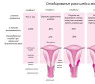 Рак матки и метастазы При раке шейки матки какие бывают метастазы