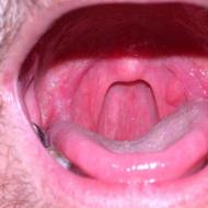 口蓋の炎症：原因と治療方法